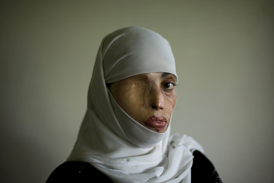 Irum Saeed, 30,  was burned on her face, back and shoulders when a boy whom she rejected for marriage threw acid on her. She has undergone plastic surgery 25 times