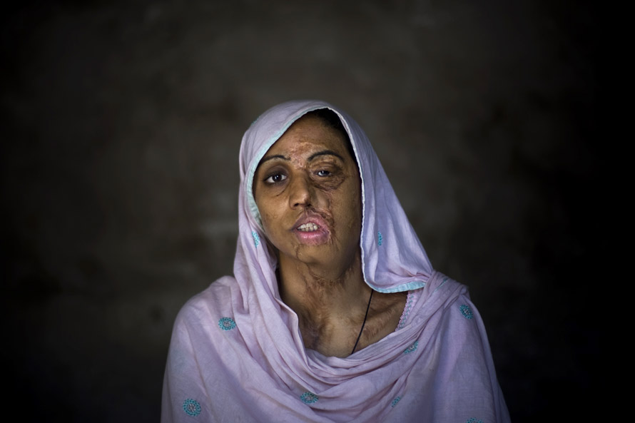 Shameem Akhter, 18 was raped by three boys who then threw acid on her. Shameem has undergone plastic surgery 10 times.