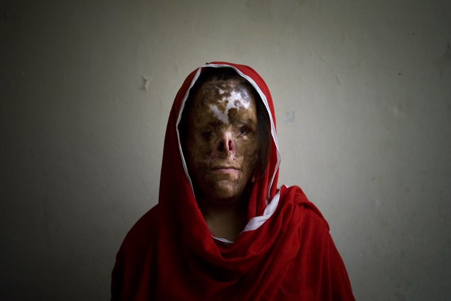 Najaf Sultana, 16.At the age of five Najaf was burned by her father while she was sleeping, because he didn't want to have another girl in the family. Najaf became blind and after being abandoned by both her parents she now lives with relatives. She has undergone plastic surgery 15 times.