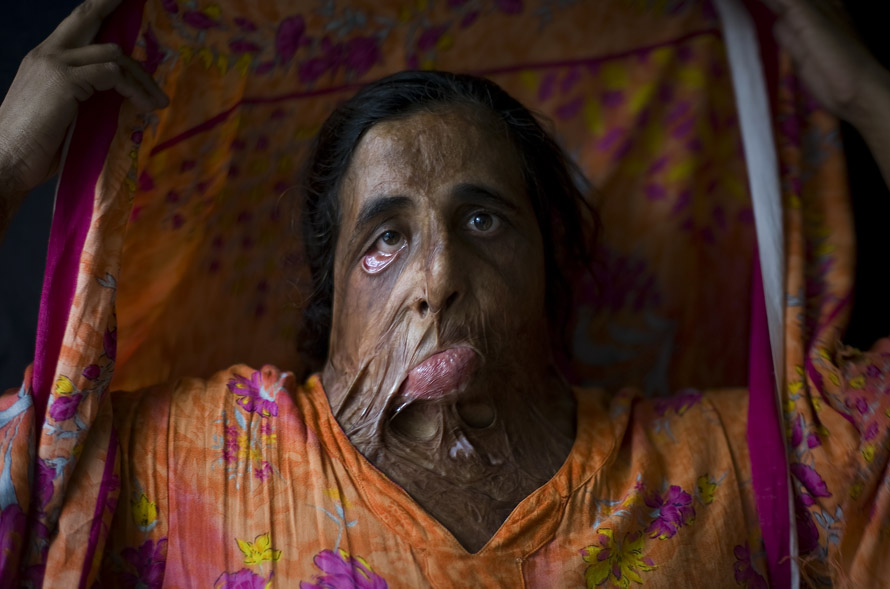 Shahnaz Bibi, 35. Ten years ago Shahnaz was burned with acid by a relative due to a familial dispute. She has never undergone plastic surgery.