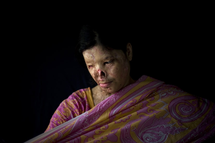 Kanwal Kayum, 26. Kanwal was burned with acid  by a boy whom she rejected for marriage. She has never undergone plastic surgery.