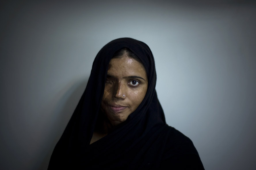 Munira Asef, 23.Munira was burned with acid  by a boy whom she rejected for marriage. She has undergone plastic surgery 7 times.