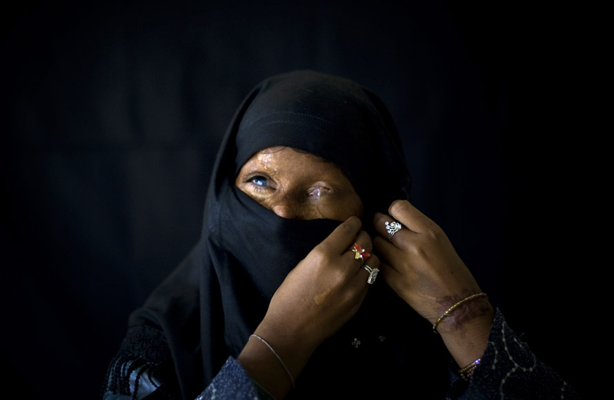 Zainab Bibi, 17, was burned on her face with acid thrown by a boy whom she rejected for marriage . She has undergone plastic surgery several times to try to recover from her scars.