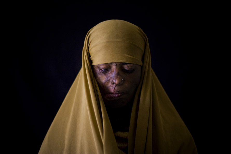 Naila Farhat, 19, was burned on her face with acid thrown by a boy whom she rejected for marriage. She has undergone plastic surgery several times.