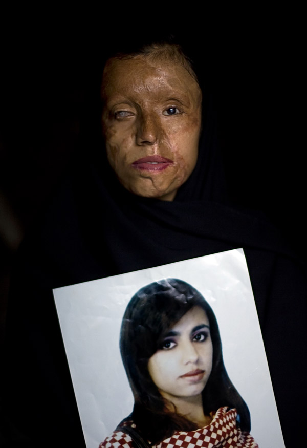 Saira Liaqat, 26, holds a portrait of herself before being burned. When she was fifteen, Saira was married to a relative who would later attack her with acid after insistently demanding her to live with him, although the families had agreed she wouldn't join him until she finished school. Saira has undergone plastic surgery 9 times.