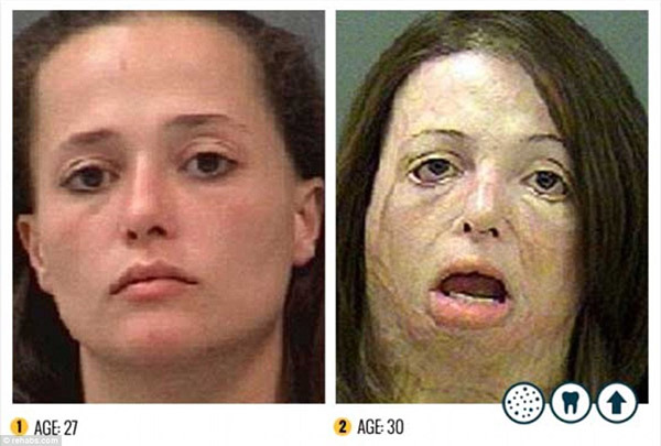 crackheads before and after - 1 Age 27 2 Age 30