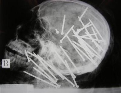 The New South Wales Police released this X ray showing a murder victim on April 29, 2009.