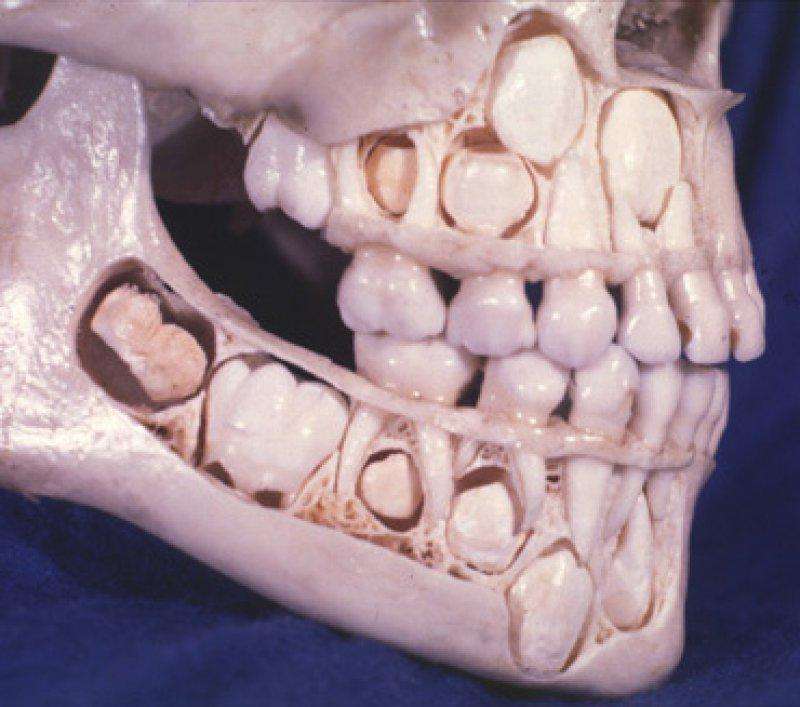 The skull of a child before losing its baby teeth.