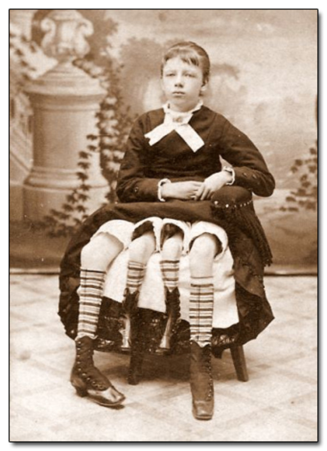 Myrtle Corbin, who was born in 1868 with an extra pelvis. Myrtle spent her early years in a circus sideshow.