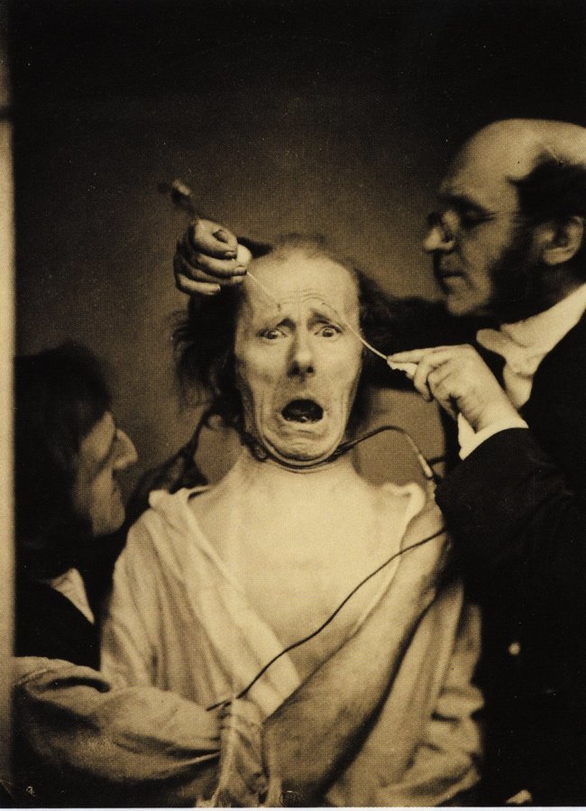 Neurologist Duchenne de Boulogne electrocuting a man's face in order to study facial muscles. France.