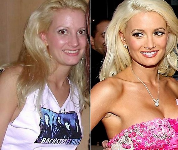 Celebrity Plastic Surgery Before and After