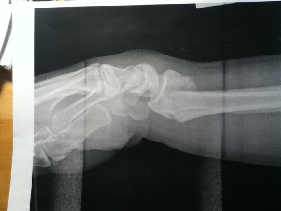 I broke my wrist!