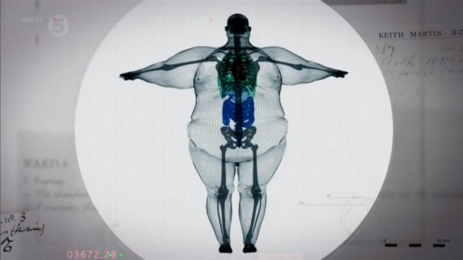 this X Ray shows Keith Martin who weights 900 lbs. You can see that his small skeleton has to support this enormous weight.