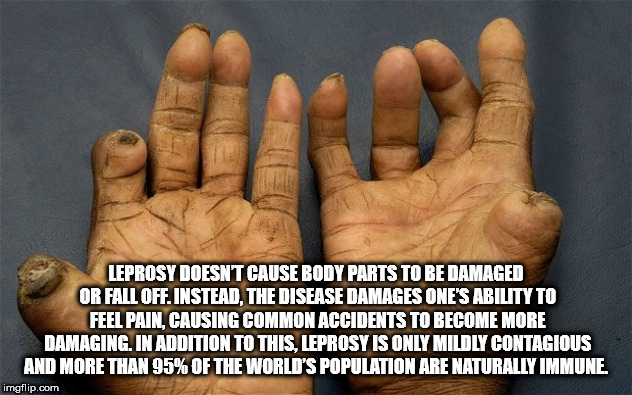 leprosy patient - Leprosy Doesnt Cause Body Parts To Be Damaged Or Fall Off. Instead, The Disease Damages One'S Ability To Feel Pain, Causing Common Accidents To Become More Damaging. In Addition To This, Leprosy Is Only Mildly Contagious And More Than 95