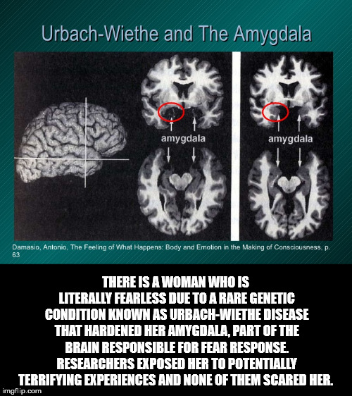 brain - UrbachWiethe and The Amygdala amygdala amygdala Damasio, Antonio, The Feeling of What Happens Body and Emotion in the Making of Consciousness. p. There Is A Woman Who Is Literally Fearless Due To A Rare Genetic Condition Known As UrbachWiethe Dise