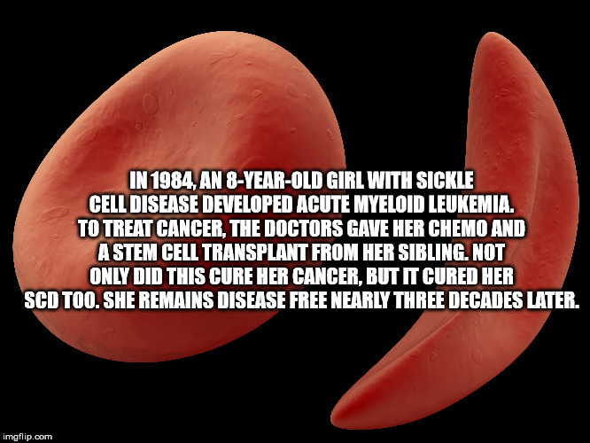 mouth - In 1984 An 8YearOld Girl With Sickle Cell Disease Developed Acute Myeloid Leukemia. To Treat Cancer. The Doctors Gave Her Chemo And A Stem Cell Transplant From Her Sibling. Not Only Did This Cure Her Cancer, But It Cured Her Scd Too. She Remains D