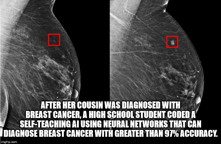 mammogram cancer - After Her Cousin Was Diagnosed With Breast Cancer, A High School Student Coded A SelfTeaching Ai Using Neural Networks That Can Diagnose Breast Cancer With Greater Than 97% Accuracy. imgflip.com