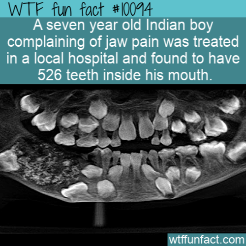 india boy with 500 teeth - Wtf fun fact A seven year old Indian boy complaining of jaw pain was treated in a local hospital and found to have 526 teeth inside his mouth. wtffunfact.com