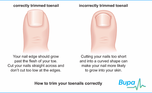 ingrown toenail hangnail - correctly trimmed toenail incorrectly trimmed toenail Your nail edge should grow past the flesh of your toe. Cut your nails straight across and don't cut too low at the edges. Cutting your nails too short and into a curved shape