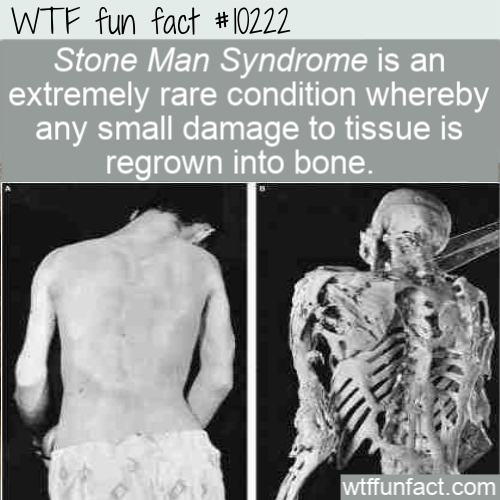 fibrodysplasia ossificans progressiva - Wtf fun fact Stone Man Syndrome is an extremely rare condition whereby any small damage to tissue is regrown into bone. wtffunfact.com