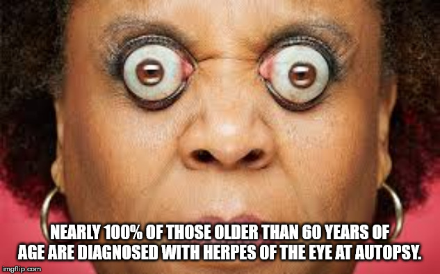 guiness world record eyes - Nearly 100% Of Those Older Than 60 Years Of Age Are Diagnosed With Herpes Of The Eye At Autopsy imgflip.com