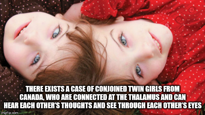 hogan twins - . There Exists A Case Of Conjoined Twin Girls From Canada, Who Are Connected At The Thalamus And Can Hear Each Other'S Thoughts And See Through Each Other'S Eyes imgflip.com