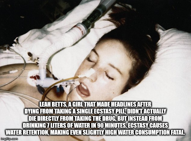 leah betts - Leah Betts, A Girl That Made Headlines After Dying From Taking A Single Ecstasy Pill, Didnt Actually Die Directly From Taking The Drug, But Instead From Drinking 7 Liters Of Water In 90 Minutes. Ecstasy Causes Water Retention, Making Even Sli