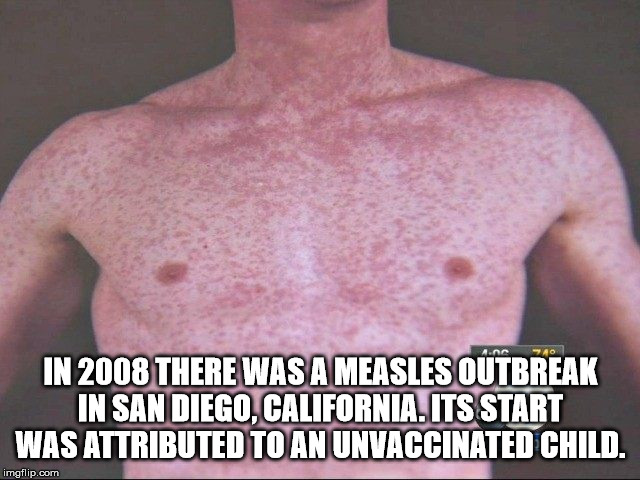 kanye west meme - In 2008 There Was A Measles Outbreak In San Diego, California.Its Start Was Attributed To An Unvaccinated Child. imgflip.com