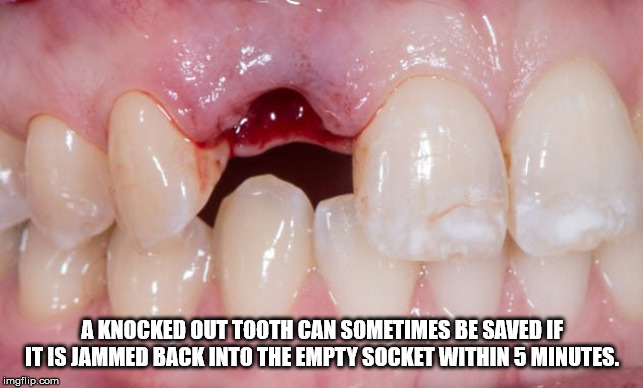 tooth - A Knocked Out Tooth Can Sometimes Be Saved If It Is Jammed Back Into The Empty Socket Within 5 Minutes. imgflip.com