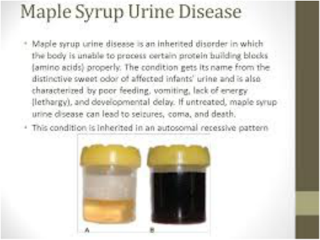 maple syrup urine disease - Maple Syrup Urine Disease Maple syrup urine diseases an inherited disorder in which the body is unable to process certain protein building blocks amino acids properly. The condition gets its name from the distinctive sweet odor