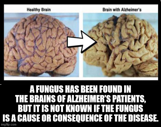parade - Healthy Brain Brain with Alzheimer's A Fungus Has Been Found In The Brains Of Alzheimer'S Patients, But It Is Not Known If The Fungus Is A Cause Or Consequence Of The Disease. imgflip.com