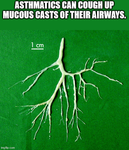 bronchial cast mucus - Asthmatics Can Cough Up Mucous Casts Of Their Airways. 1 cm imgflip.com