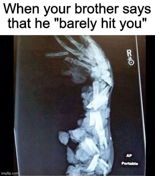 hand in meat grinder xray - When your brother says that he "barely hit you" R Ap Portable imgflip.com