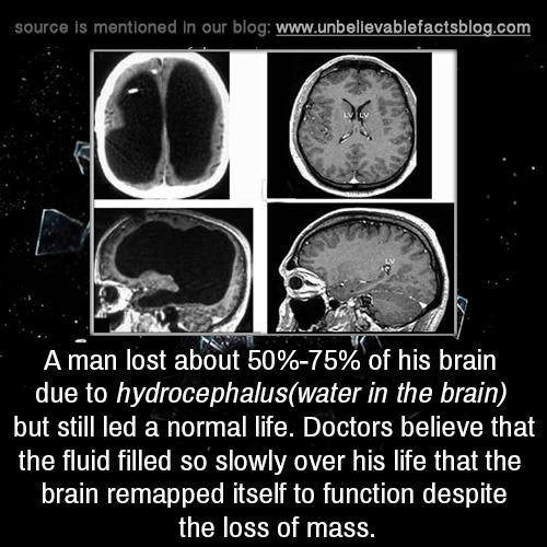 brain - source is mentioned in our blog u A man lost about 50%75% of his brain due to hydrocephaluswater in the brain but still led a normal life. Doctors believe that the fluid filled so slowly over his life that the brain remapped itself to function des