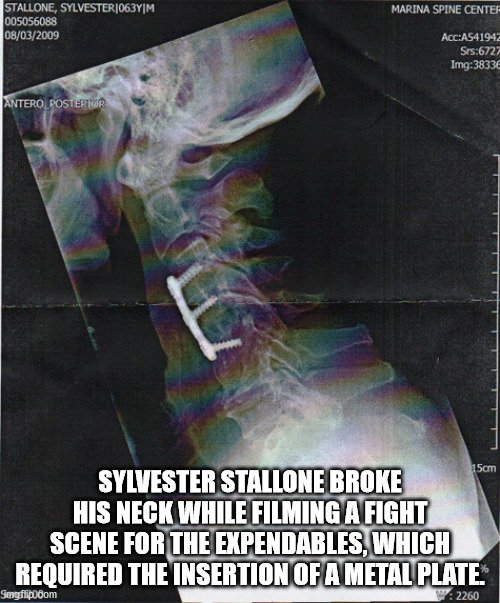 Marina Spine Center Stallone, Sylvester|063YM 005056088 08032009 AccA541942 Srs6727 Img3833 Antero Posterior 15cm Sylvester Stallone Broke His Neck While Filming A Fight Scene For The Expendables, Which Required The Insertion Of A Metal Plate Smgflipboom…