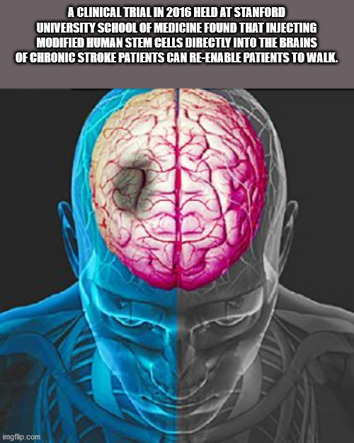 people with brain stroke - A Clinical Trial In 2016 Held At Stanford University School Of Medicine Found That Injecting Modified Human Stem Cells Directly Into The Brains Of Chronic Stroke Patients Can ReEnable Patients To Walk. imgflip.com