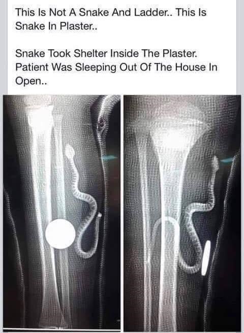 knee xray meme - This Is Not A Snake And Ladder.. This is Snake In Plaster.. Snake Took Shelter Inside The Plaster. Patient Was Sleeping Out Of The House In Open..