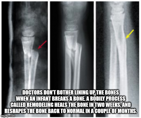 medical radiography - Doctors Dont Bother Lining Up The Bones When An Infant Breaks A Bone A Bodily Process Called Remodeling Heals The Bone In Two Weeks, And Reshapes The Bone Back To Normal In A Couple Of Months. imgflip.com