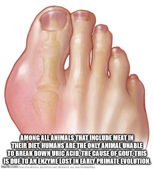 hand - Among All Animals That Include Meat In Their Diet, Humans Are The Only Animal Unable To Break Down Uric Acid, The Cause Of Gout This Is Due To An Enzyme Lost In Early Primate Evolution. imgflipGobation For Medical Education And Research. All Rights