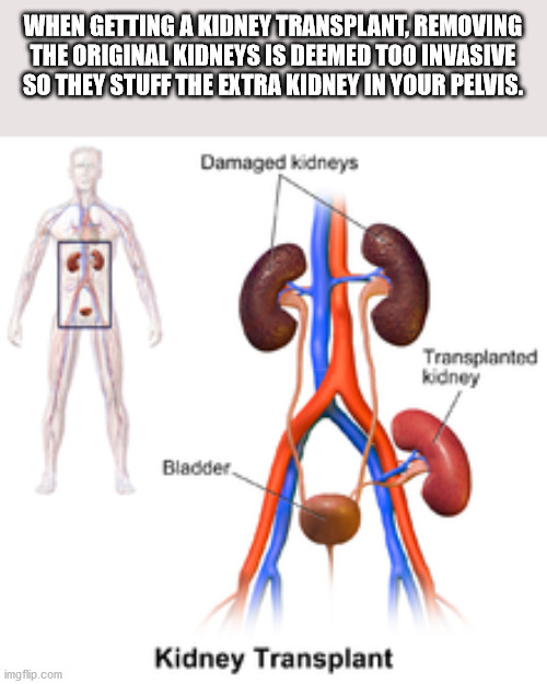 kidney transplant surgery - When Getting A Kidney Transplant, Removing The Original Kidneys Is Deemed Too Invasive So They Stuff The Extra Kidney In Your Pelvis. Damaged kidneys Transplanted kidney Bladder Kidney Transplant imgflip.com