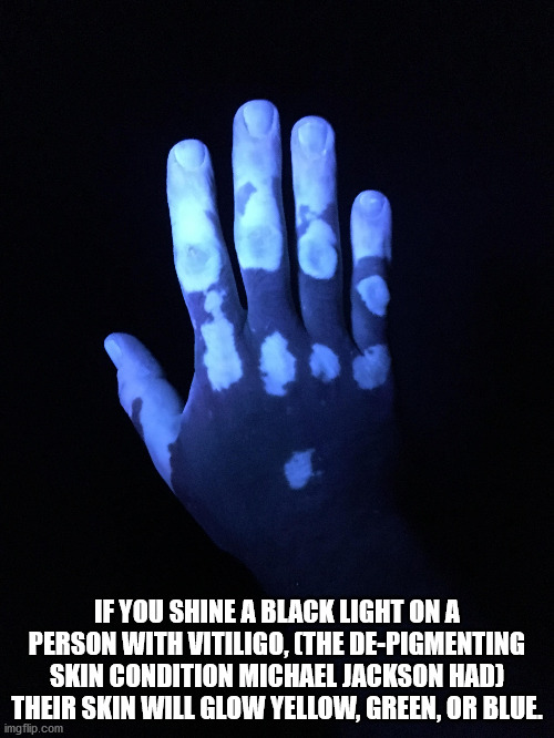 アーム ライト - If You Shine A Black Light On A Person With Vitiligo, The DePigmenting Skin Condition Michael Jackson Had Their Skin Will Glow Yellow, Green, Or Blue imgflip.com