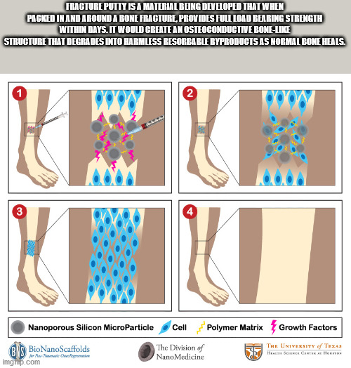 Fracture Putty Is A Material Being Developed That When Packed In And Around A Bone Fracture,Provides Full Load Bearing Strength Within Days. It Would Create An Osteoconductine Bone Structure That Degrades Into Harmless Resorba Ble Byproducts As Normal Bon