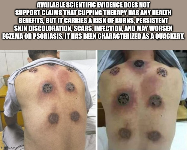 neck - Available Scientific Evidence Does Not Support Claims That Cupping Therapy Has Any Health Benefits, But It Carries A Risk Of Burns, Persistent Skin Discoloration, Scars, Infection, And May Worsen Eczema Or Psoriasis. It Has Been Characterized As A…