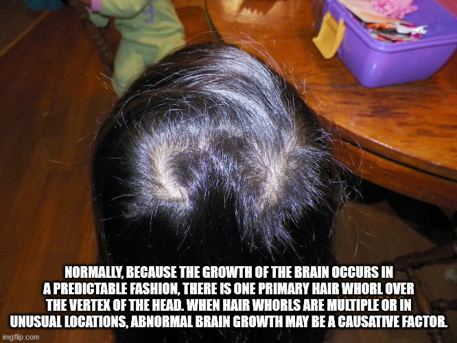 Normally, Because The Growth Of The Brain Occurs In A Predictable Fashion, There Is One Primary Hair Whorl Over The Vertex Of The Head. When Hair Whorls Are Multiple Or In Unusual Locations, Abnormal Brain Growth May Be A Causative Factor imgflip.com