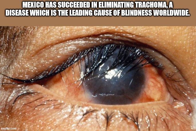 trachoma trichiasis - Mexico Has Succeeded In Eliminating Trachoma, A Disease Which Is The Leading Cause Of Blindness Worldwide. imgflip.com