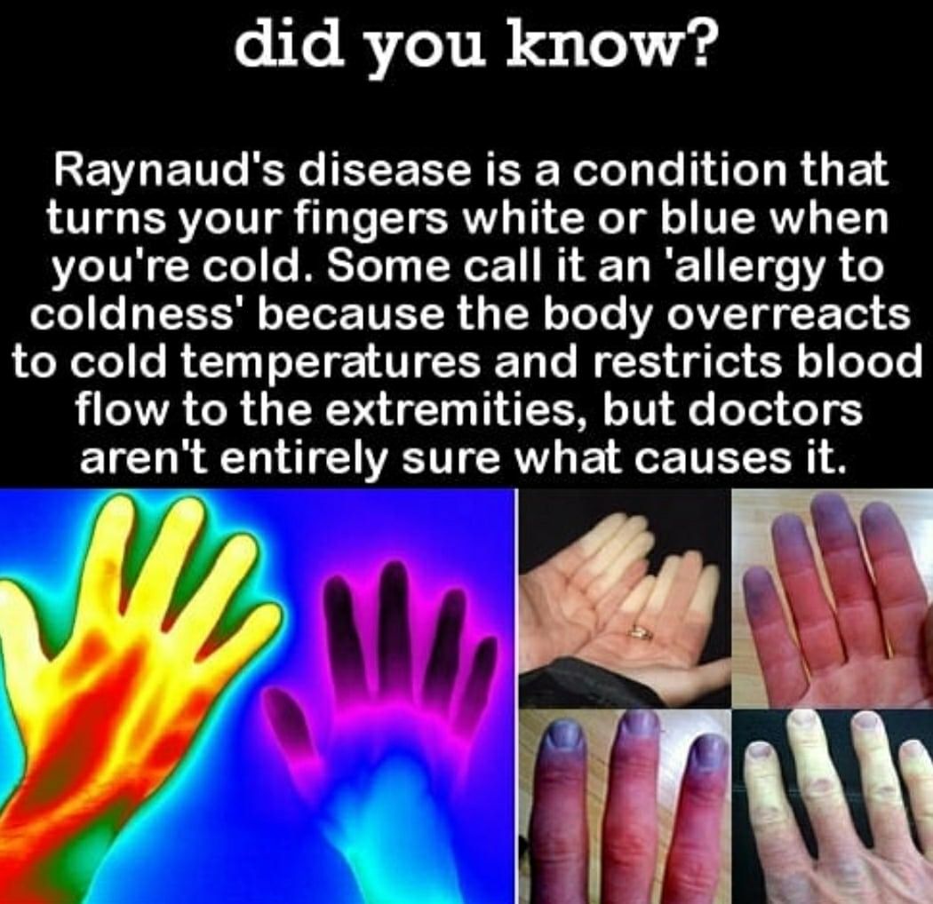 raynaud's phenomenon memes - did you know? Raynaud's disease is a condition that turns your fingers white or blue when you're cold. Some call it an 'allergy to coldness' because the body overreacts to cold temperatures and restricts blood flow to the extr