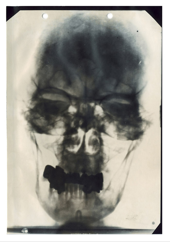 An x-ray of Hitler's skull