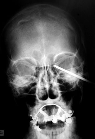Amazing X-rays
