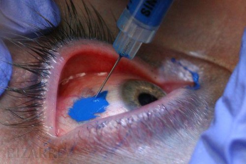 Tattoo ink is injected into the Eye effectively rendering it the color of the ink.
It is said the be virtually painless.