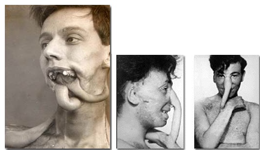 This is a pedicle graft, a procedure developed by Dr. Harold Gillies to treat disfigured soldiers during World War I, back when skin grafts and reconstructive plastic surgery had a very low success rate. A flap of skin from an unaffected area of the patient's body was sewn into a tube and temporarily grafted to wherever the new body part was needed and essentially grown.